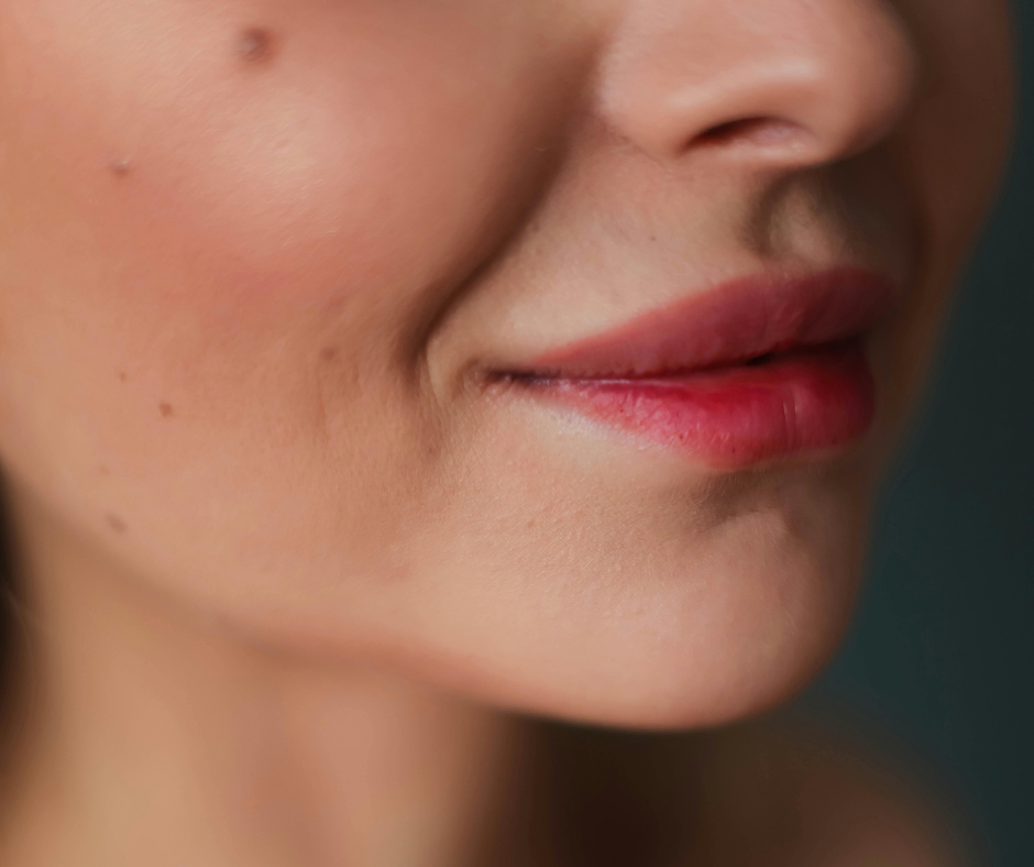 Collagen stimulation treatments for firmer, smoother, healthier-looking skin at Moore Wellness Solutions.